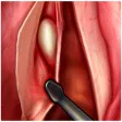 IPO Microcirurgia de Laringe