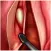 IPO Microcirurgia de Laringe
