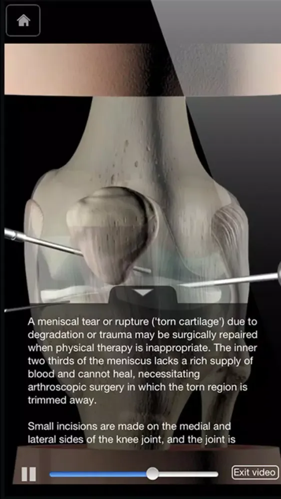 Knee Pro III Ekran Görüntüleri