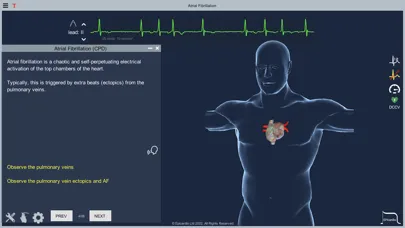 Atrial Fibrillation स्क्रीनशॉट