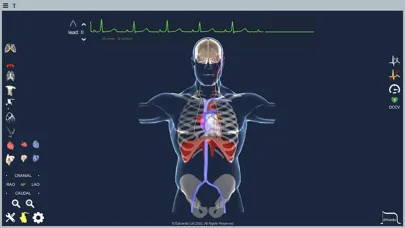 Atrial Fibrillation स्क्रीनशॉट