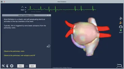 Atrial Fibrillation स्क्रीनशॉट