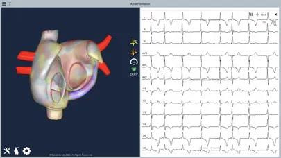 Atrial Fibrillation स्क्रीनशॉट