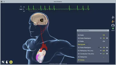 Atrial Fibrillation स्क्रीनशॉट