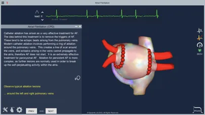 Atrial Fibrillation स्क्रीनशॉट