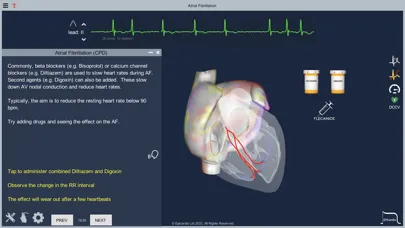 Atrial Fibrillation स्क्रीनशॉट