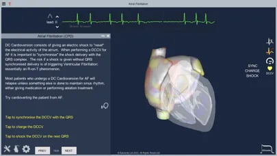 Atrial Fibrillation स्क्रीनशॉट