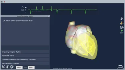 Atrial Fibrillation स्क्रीनशॉट