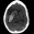 HeRS - Hemorrhage Risk Stratification Calculator