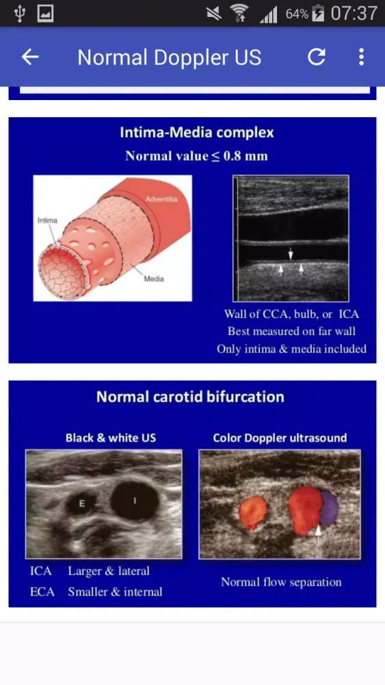 ภาพหน้าจอของ Doppler US Of Carotid arteries