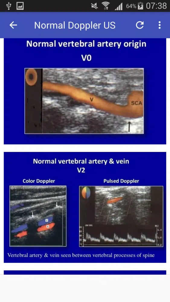 ภาพหน้าจอของ Doppler US Of Carotid arteries