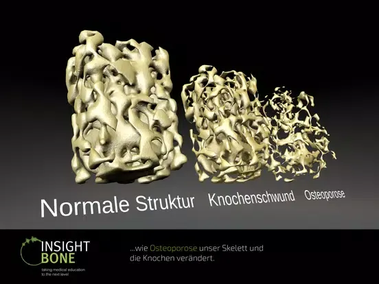 Captures d'écran de INSIGHT BONE iPad 