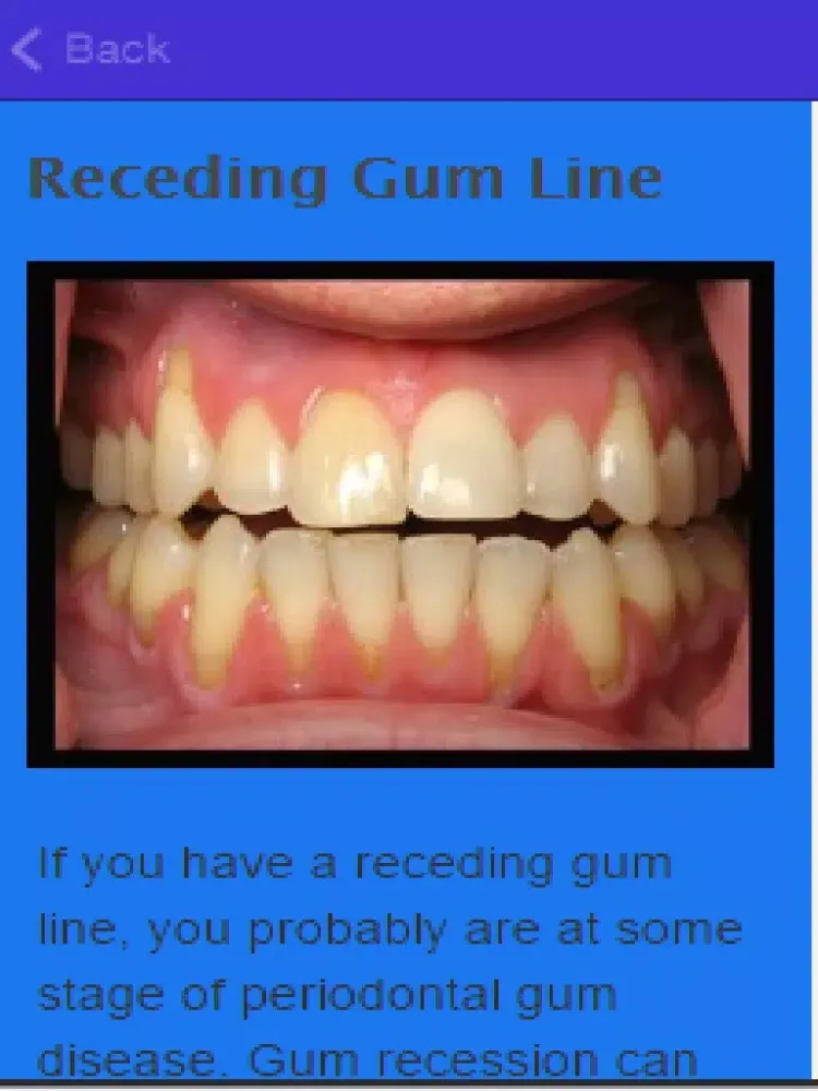 How To Stop Receding Gums iPad  Ekran Görüntüleri