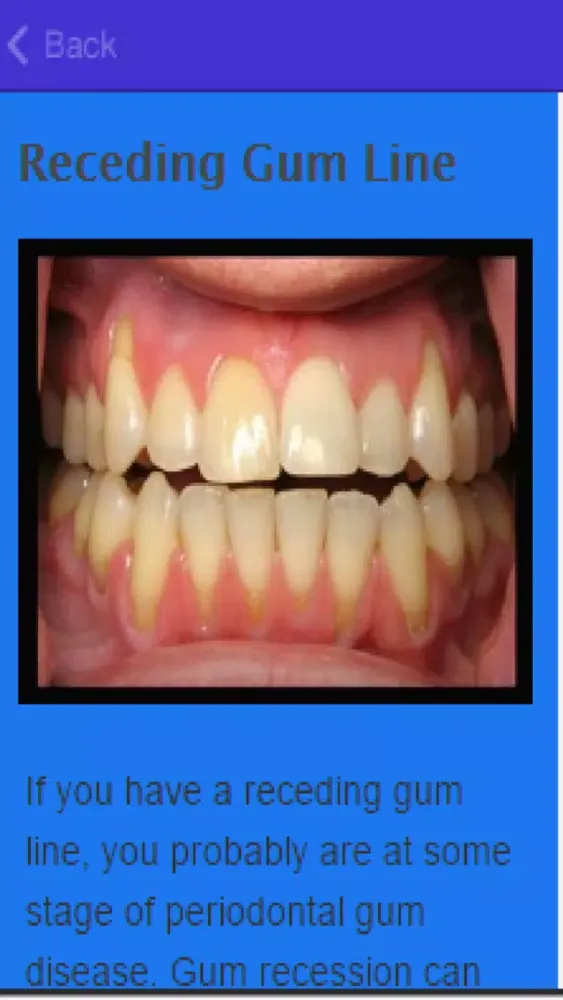How To Stop Receding Gums Ekran Görüntüleri