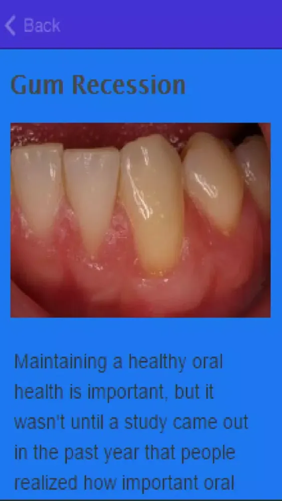 How To Stop Receding Gums Ekran Görüntüleri
