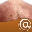 Atopic Dermatitis Atopic Dermatitis