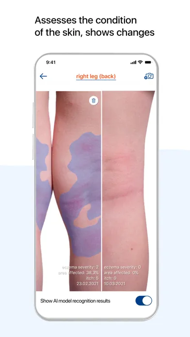Atopic App – AI Eczema Manager Screenshots