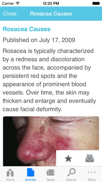 Rosacea by AZoMedical应用截图