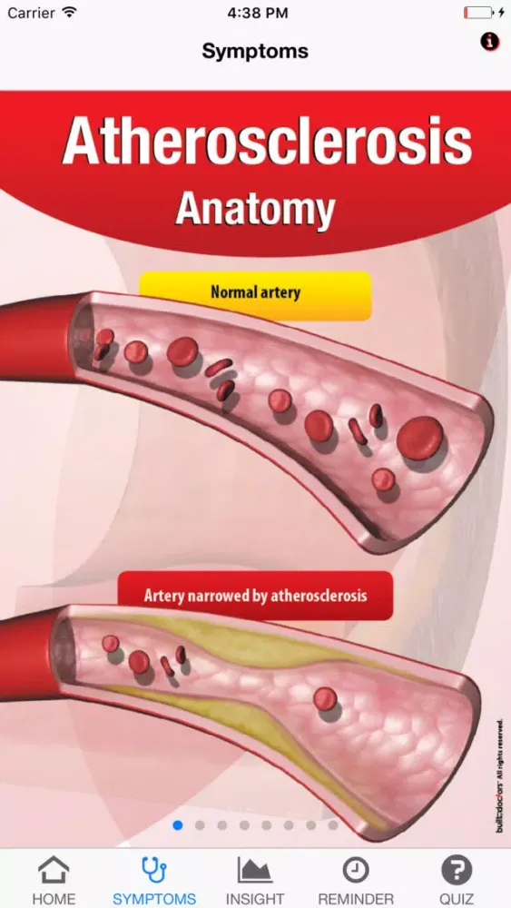 Ảnh chụp màn hình của Signs & Symptoms Atherosclerosis