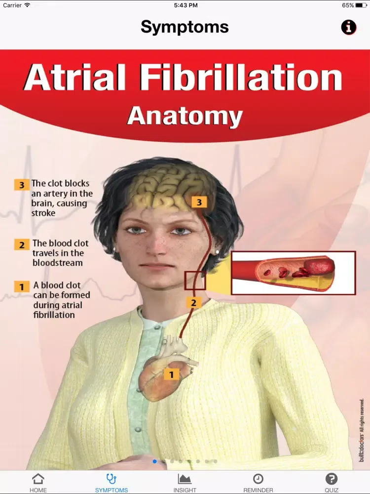 Signs & Symptoms Atrial Fibrillation iPad  Screenshots