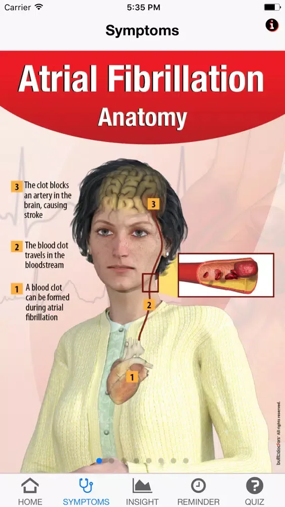 Signs & Symptoms Atrial Fibrillation Screenshots