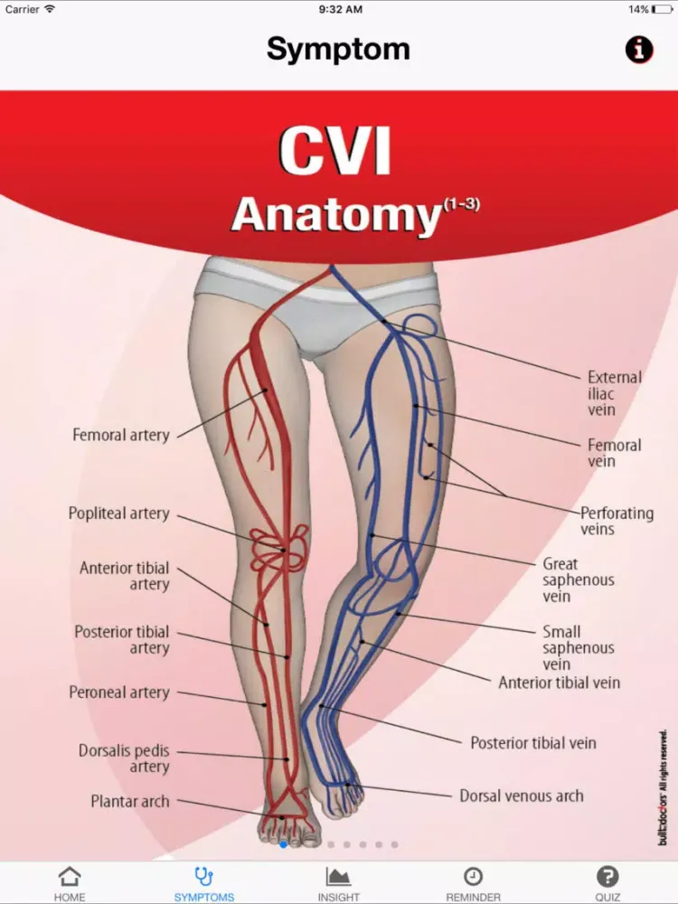 Screenshot di Signs & Symptoms Chronic Venous Insufficiency iPad 