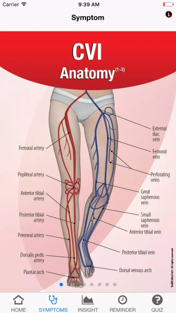 Screenshot di Signs & Symptoms Chronic Venous Insufficiency
