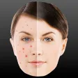 Perfect Face - Pimple, Mole and Scar Remover Perfect Face - Pimple, Mole and Scar Remover