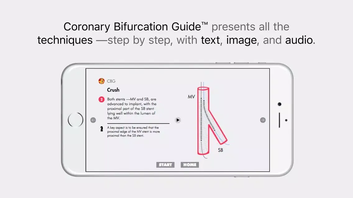 Ảnh chụp màn hình của CBG Coronary Bifurcation Guide