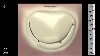 Mitral & Tricuspid Valves স্ক্রিনশট