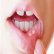 How To Get Rid Of Mouth Ulcers How To Get Rid Of Mouth Ulcers