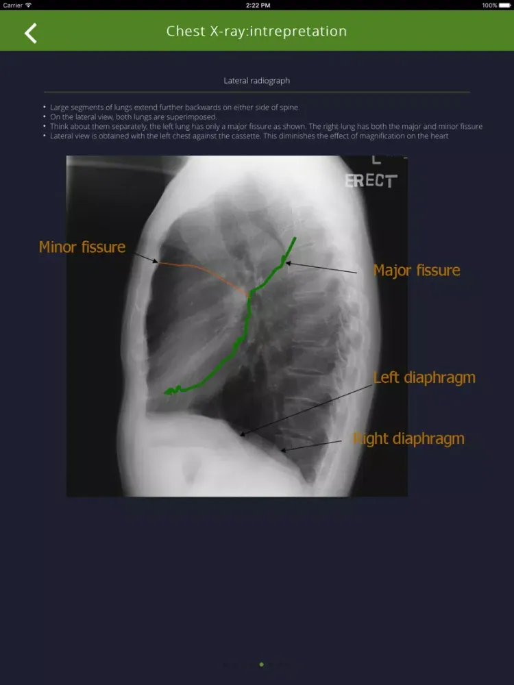 Chest Radiographs iPad  Ekran Görüntüleri