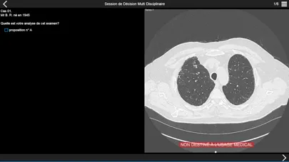 Fibrose pulmonaire 2017 স্ক্রিনশট