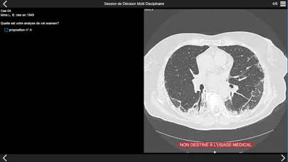 Fibrose pulmonaire 2017 স্ক্রিনশট