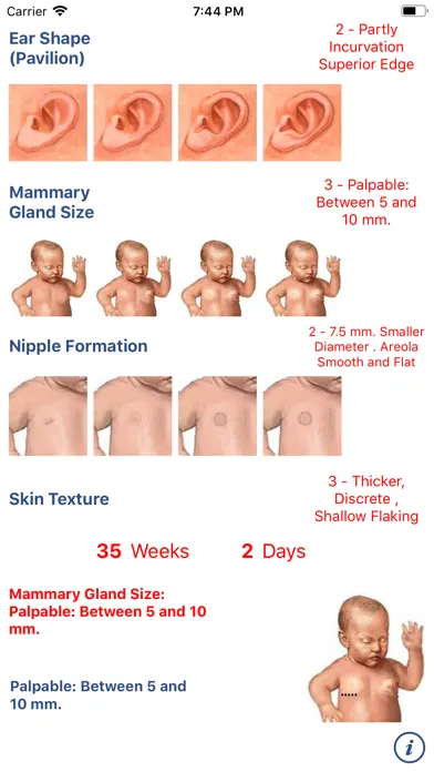 Neonatology: Test Capurro سکرین شاٹس