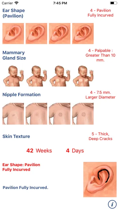 Neonatology: Test Capurro سکرین شاٹس