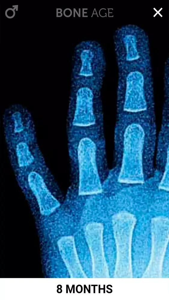 Скриншоты Bone Age Lite
