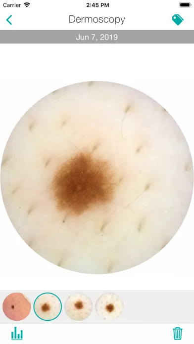صور MoleScope™