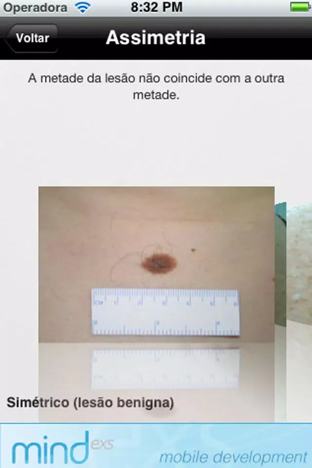 Скриншоты Melanoma iABCD rule