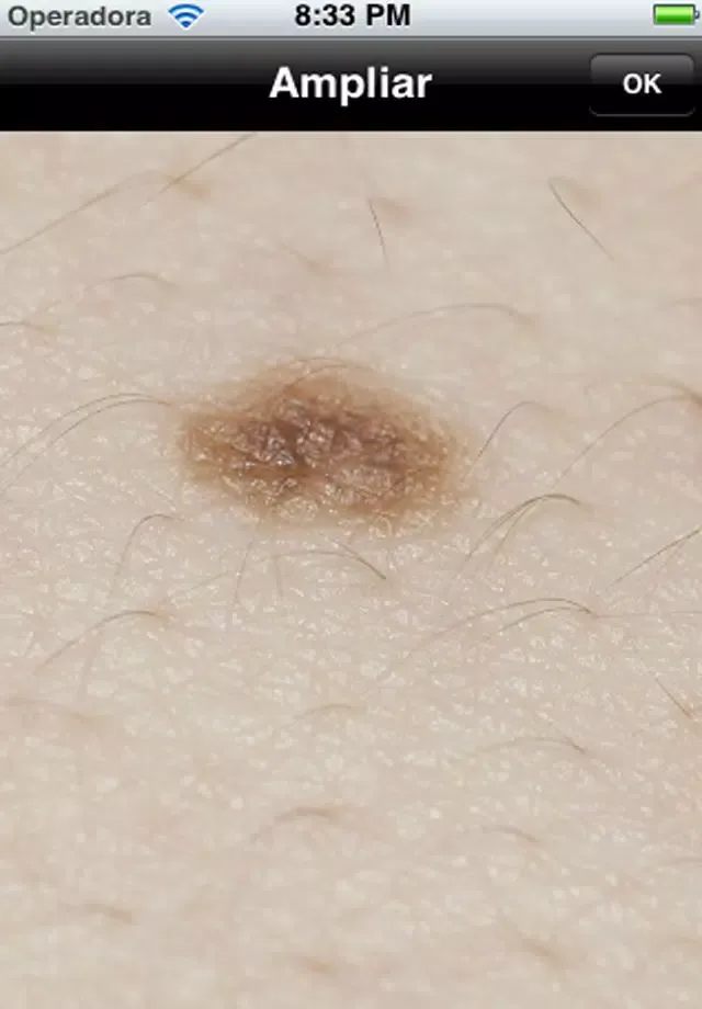 Скриншоты Melanoma iABCD rule