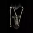 Broken Bones Broken Bones