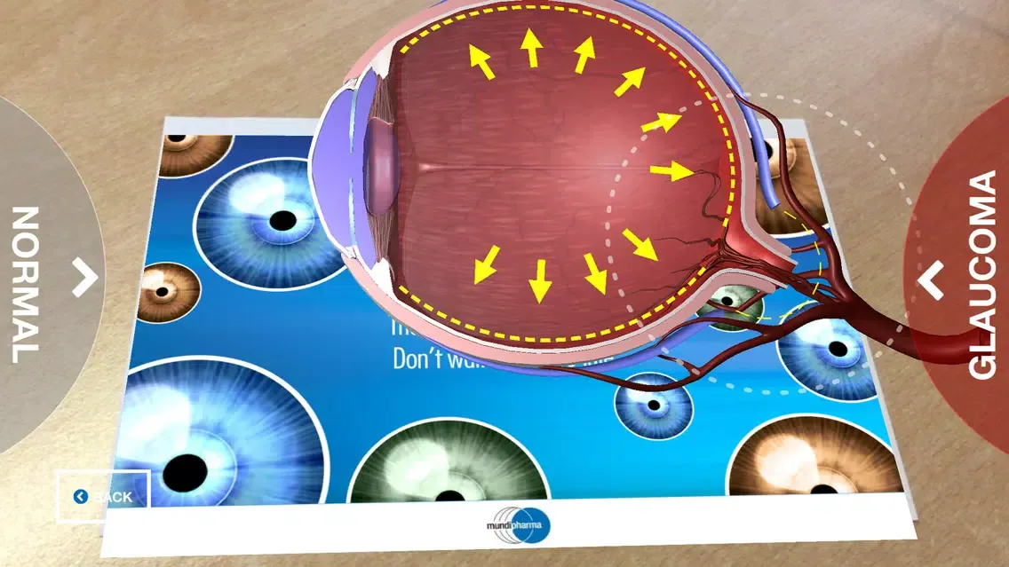 صور Glaucoma Education
