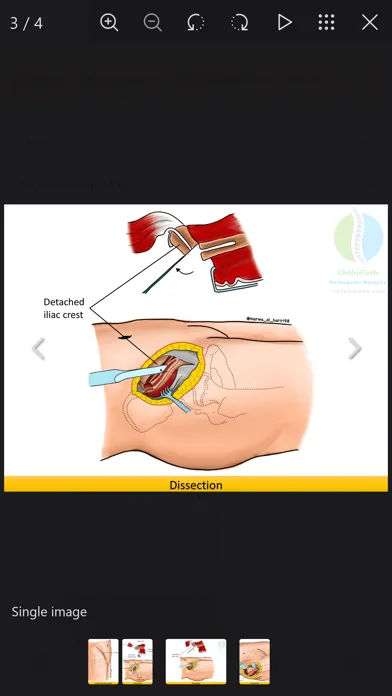 Orthopedic Surgery Approaches स्क्रीनशॉट