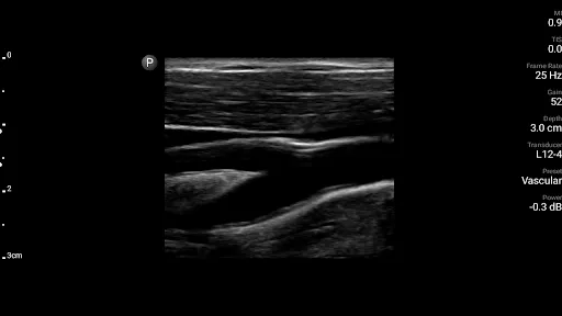 Philips Lumify Ultrasound App Ekran Görüntüleri