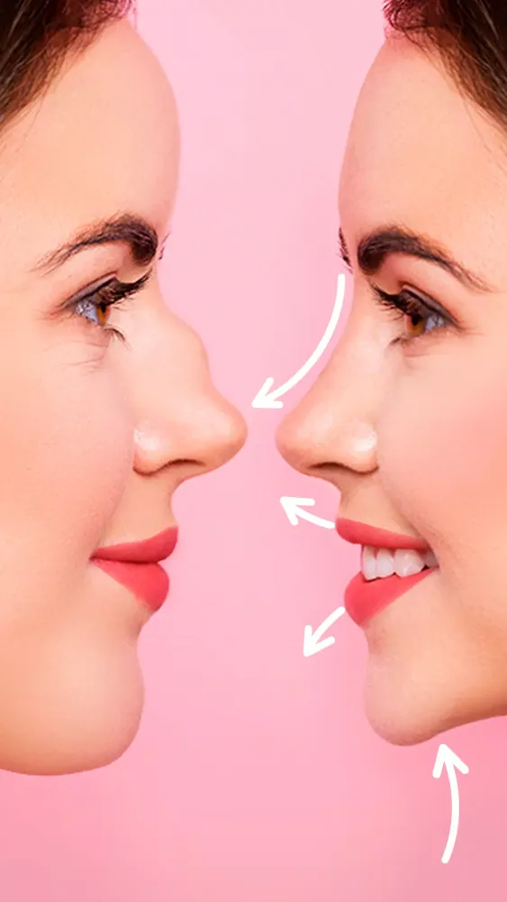 Rhinoplasty Screenshots