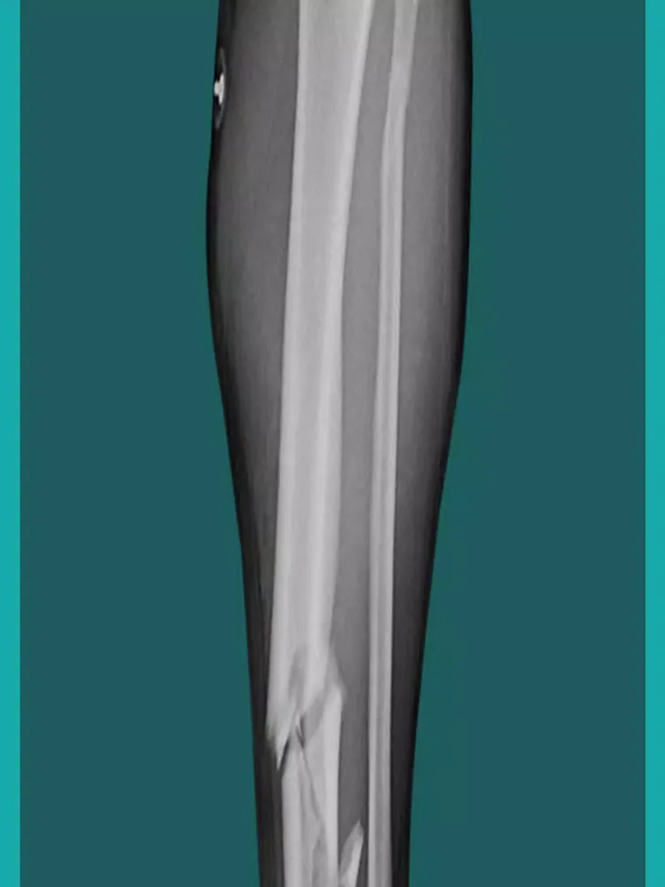 Leg Surgery Doctor Operation iPad  স্ক্রিনশট