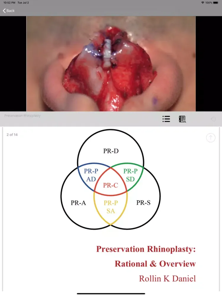 صور Preservation Rhinoplasty iPad 