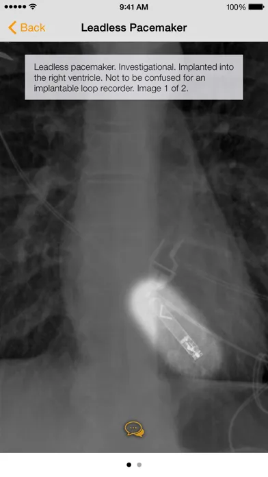 Medical Devices on Chest X-Ray應用截圖