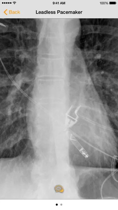 Medical Devices on Chest X-Ray應用截圖