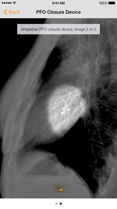 Medical Devices on Chest X-Ray應用截圖